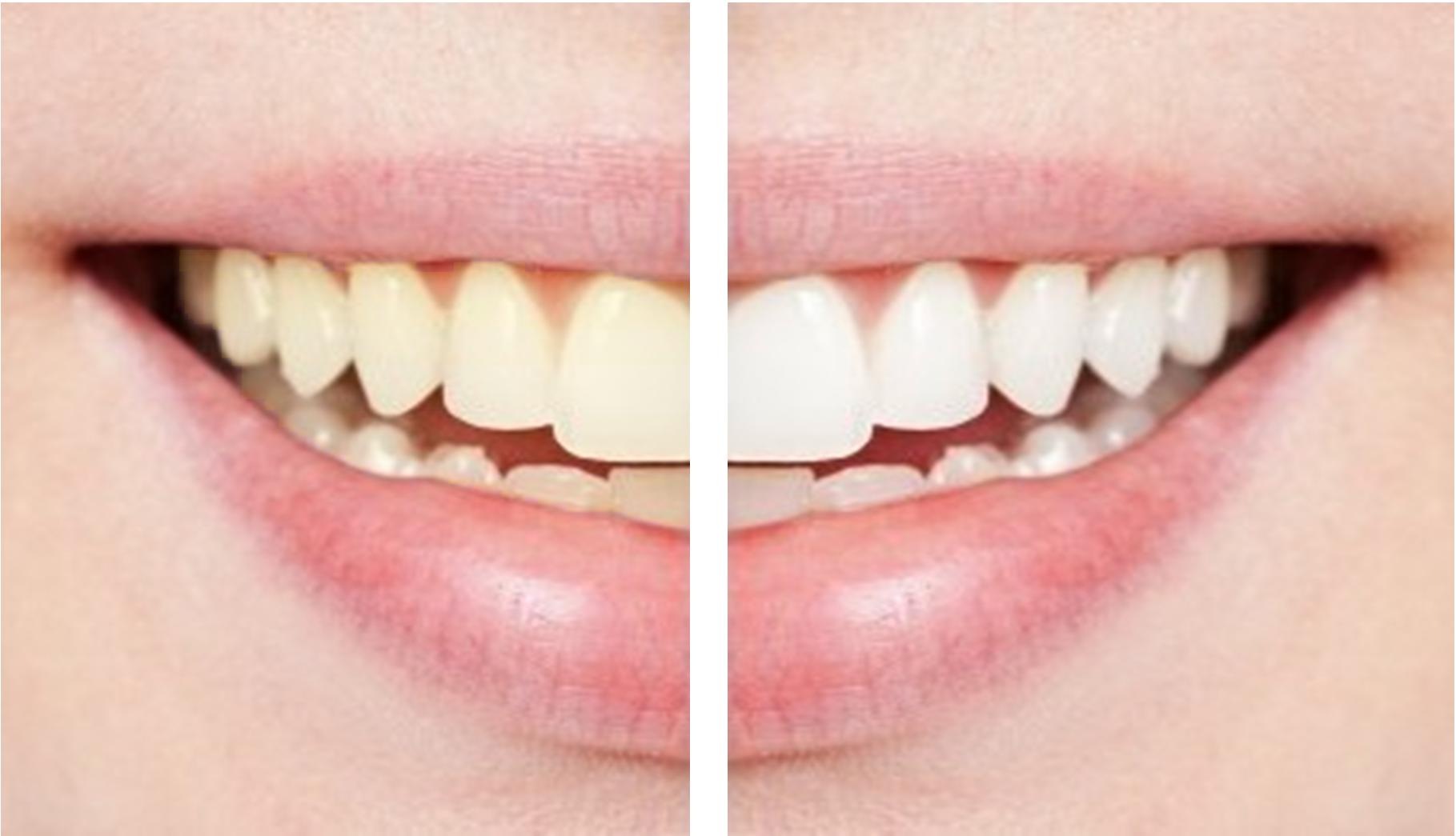 Зубы желтый чистить. Отбеливание зубов. Отбеливание зубов до и после. Зубы до и после отбеливания.