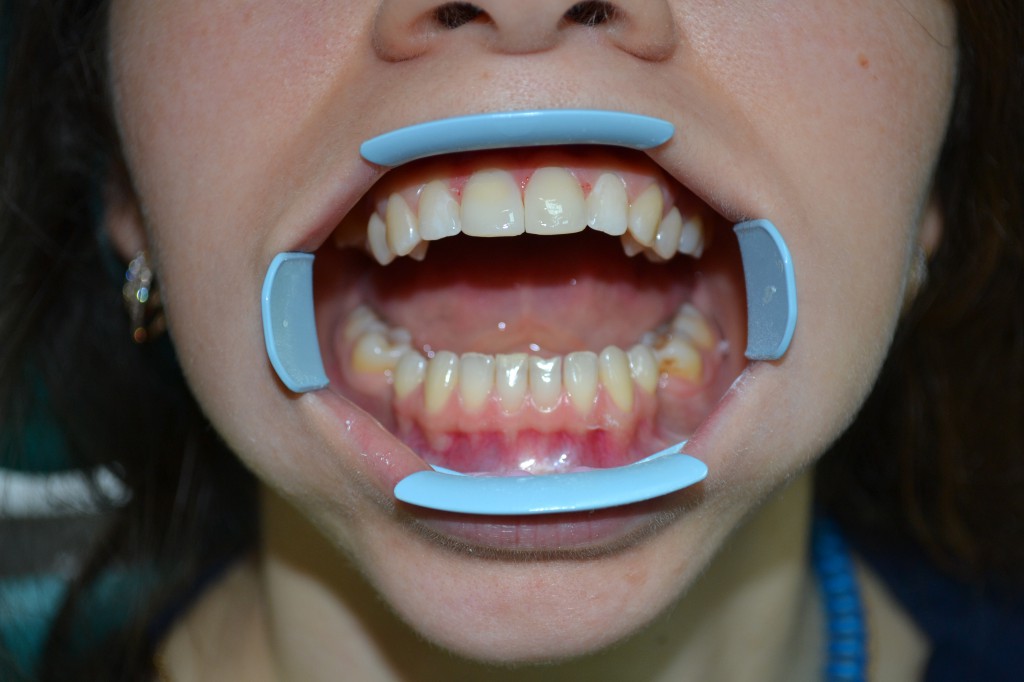 Что делают клыки зубы. Искусственные клыки на зубы. Нарощенные острые зубы.