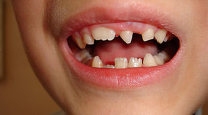Что происходит при развитии аномалий зубов?