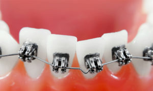 Как брекеты выравнивают зубы?