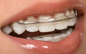 Пластинки для зубов для красивой улыбки