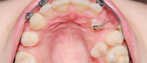 Ретинированный зуб. Задержка прорезывания