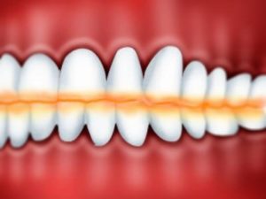 Физиологическая стираемость зубов
