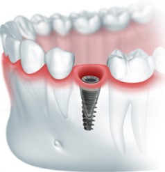 Экспресс имплантация зубов этапы