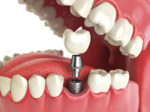 3D имплантация зубов