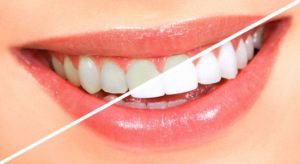 Показания и противопоказания для отбеливания зубов