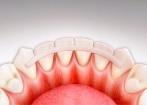 Как сохранить подвижный зуб?