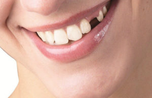 Преимущества и недостатки имплантации зубов