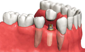 Этапы имплантации зубов за 4 дня