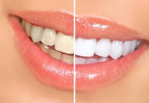 Причины изменения цвета зубов