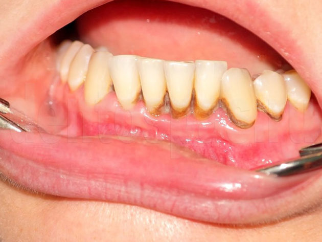 Причины пародонтоза